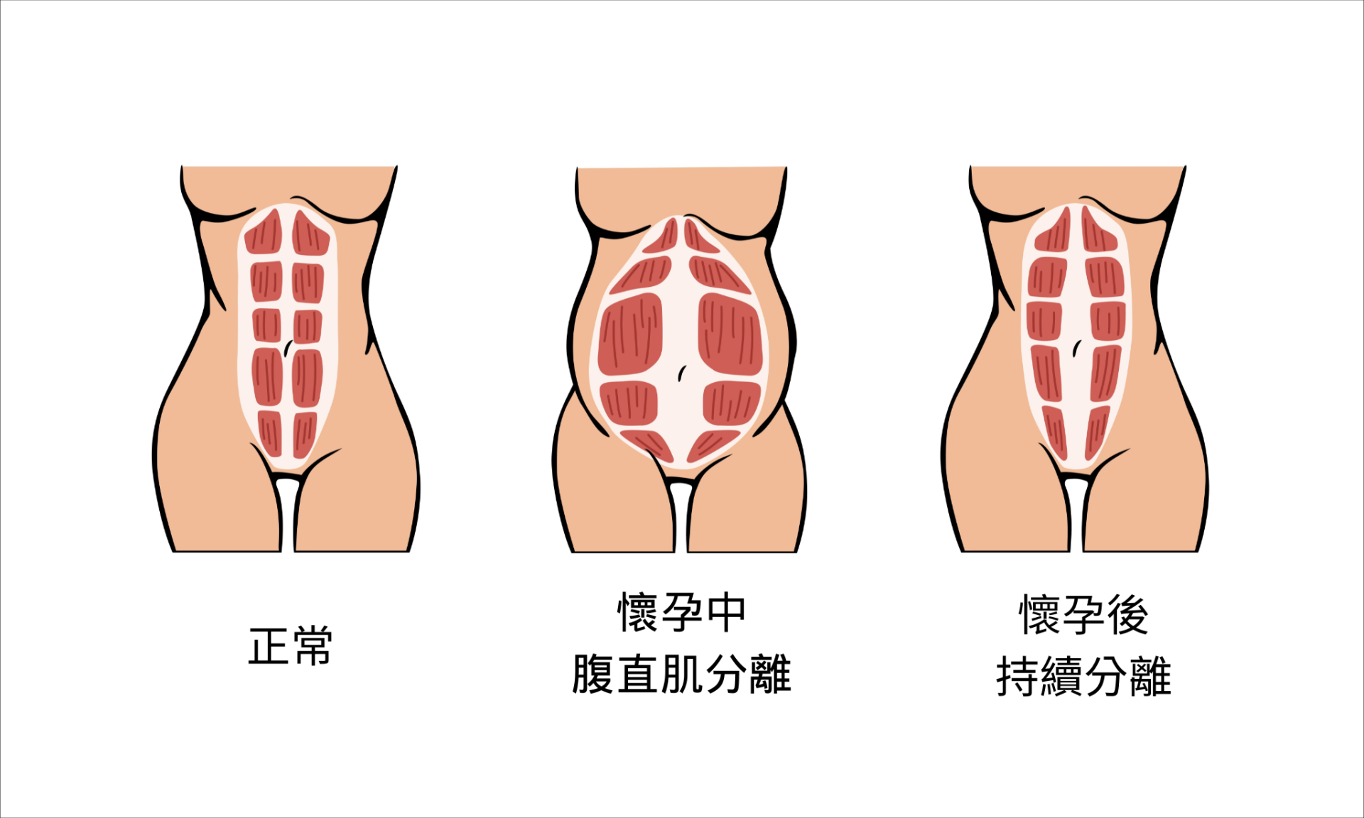 腹直肌分離症狀有哪些？2大專業修復方法，產後媽媽必看！